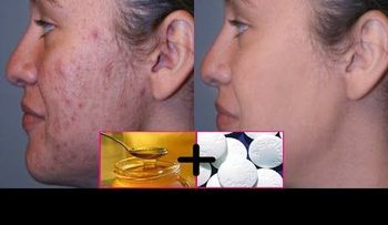 Lucirás como una princesa o un príncipe: peeling fácial con aspirina y miel durante 10 minutos. Luego mírate al espejo