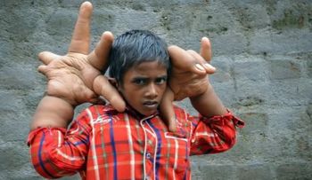 Un niño indio con manos gigantes sorprende a la comunidad médica
