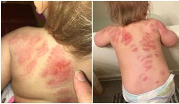 ¿La guardería sería un lugar seguro?; descubrió que su bebé fue mordido más de 25 veces 
