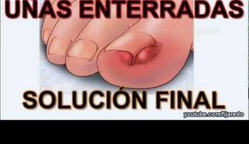 Solución sin dolor de uñas enterradas (Video)