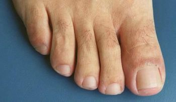 El mal olor de los pies podria combatir la malaria
