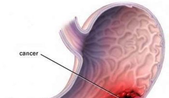 Cáncer de estómago una enfermedad silenciosa: Conoce los síntomas?