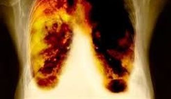El cáncer hepático y de pulmón siguen siendo letales en todas las naciones. ¿En qué países se sobrevive más 