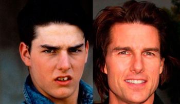 11 Personas famosas que tienen dientes falsos