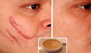 Para eliminar cicatrices de cualquier parte del cuerpo en 2 semanas prueba esta crema casera!