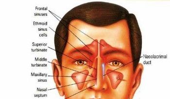 Remedios caseros para la sinusitis