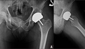 Denuncian práctica de cambiar implantes
