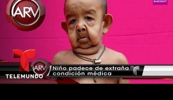 Un niño con una rara enfermedad que lo hace ver como un anciano