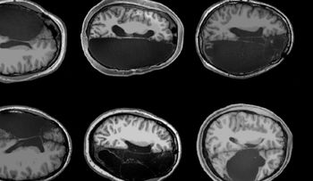 ¿Es posible vivir con medio cerebro?