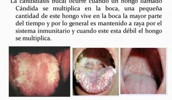 ¿Cómo se cura la candidiasis?