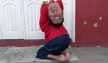 Historia del hombre que nació con la cabeza al revés