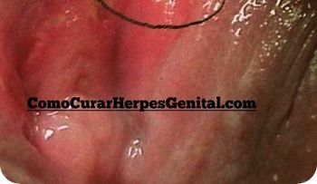Cómo curar la candidiasis genital masculina