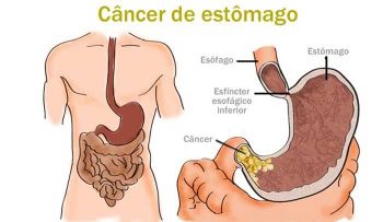 Estas señales me alertaron que tenía comienzo de un cáncer SILENCIOSO de estómago y pude evitarlo