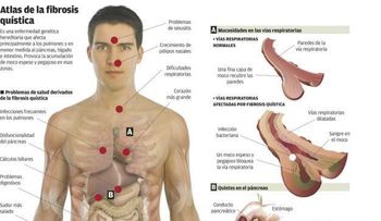 Fibrosis Quística; causas y tratamiento (VIDEO)