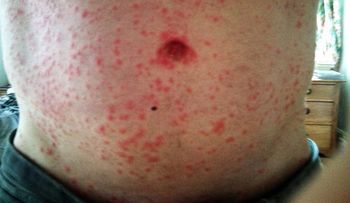 Virus El Mayaro detectado en Haití, tiene preocupado a dominicanos; SP vigila 