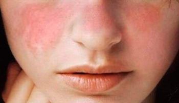 Lupus, la enfermedad autoinmune que azota al cuerpo