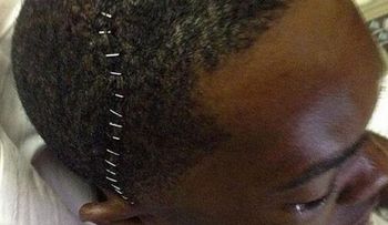 Aroldis Chapman sube a las redes foto de su cabeza grapada tras cirugía 