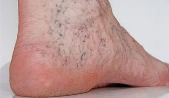 Ejercicios para eliminar las varices