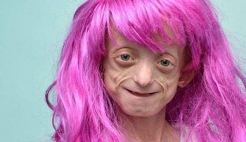 Muere mujer de 20 años que parecía una niña, por una rara enfermedad