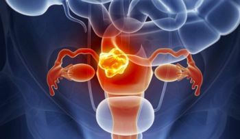 Cáncer de cuello uterino amenaza la vida de las venezolanas