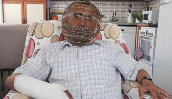 Se coloca una jaula para dejar de fumar