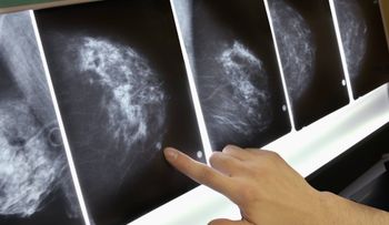 En un avance sin precedente en el mundo, un equipo de EE.UU logra eliminar un tumor a una paciente con metástasis