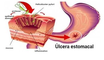 5 remedios efectivos para eliminar el Helicobacter Pylori 