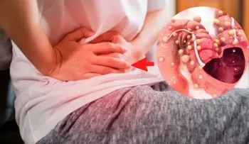 El 90 % de los casos de cáncer de colon tiene cura si se detecta a tiempo