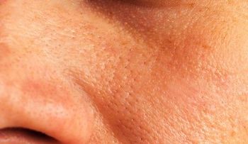 5 soluciones naturales para reducir los poros dilatados de la piel