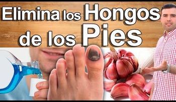 Remedio que no falla para eliminar los hongos