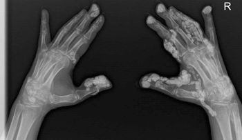 "Mi cuerpo se está convirtiendo en piedra", la terrible historia de Virdee, quien era profesora en Inglaterra         