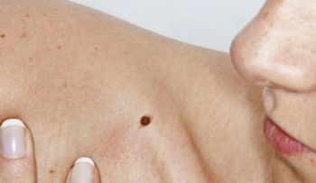 Cómo reconocer el cáncer de piel â?" Esto podría salvar tu vida!