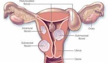Explorar las alternativas de tratamiento de las mujeres con fibromas