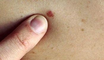 6 señales para identificar el cáncer en la piel
