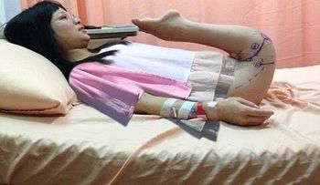 Una mujer con una extraña enfermedad que le permite doblar sus piernas 