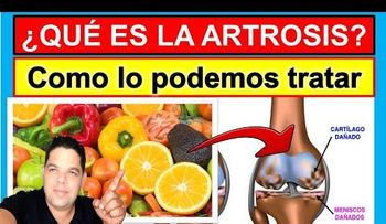 Cómo tratar efectivamente la artrosis