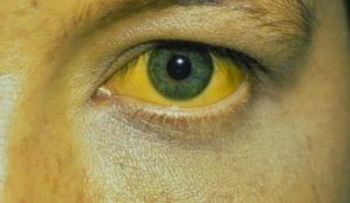Si te ves así, mándate para el médico: Podría tener hepatitis C 