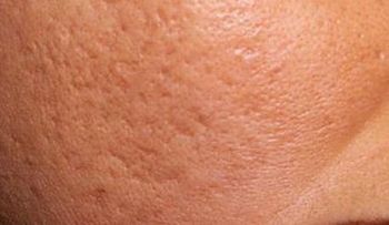  3 Remedios naturales para las cicatrices del acné 