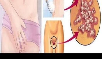 5 Remedios preparado en la casa que eliminan para SIEMPRE los hongos vaginales