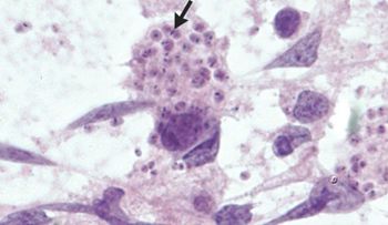 Fue al médico por dolor de cabeza y encontraron parásitos en su cerebro