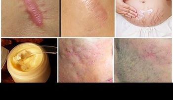 Cómo quitar las estrías en pocos días  IMPRESIONANTE!  (VIDEO)