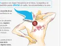 Herpes zóster: el virus que puede reactivarse décadas después y cómo prevenirlo
