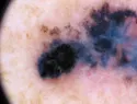 Merck y Moderna avanzan en vacuna personalizada contra el melanoma