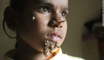 Niña de Bangladesh tiene síndrome del "hombre-árbol"