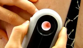 Revisiones regulares de la piel ayudan a detectar el melanoma y otros cánceres de la piel