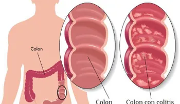 Colitis ulcerosa, y cómo superar esta enfermedad