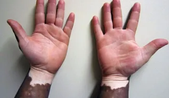 El vitiligo se puede tratar con remedios naturales; hojas de margosa, miel de abeja y aloe vera