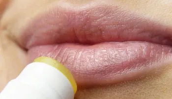 Herpes labial: síntomas y tratamiento