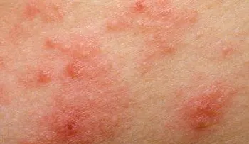 ¿Cómo saber si se trata de una reacción alérgica o una dermatitis?