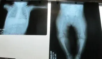 Hallan 7 agujas clavadas en bebé de 7 meses en Perú 